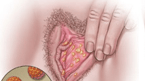 симптомы венерических болезней у женщин