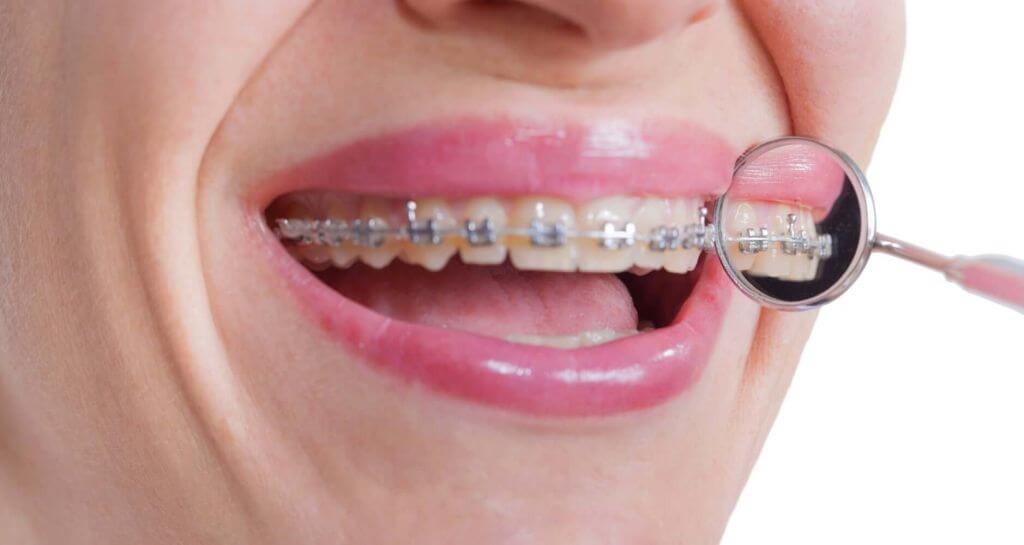 Щель между передними зубами: что делать? - Венерические заболевания у ...