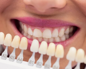 Преимущества отбеливания зубов 